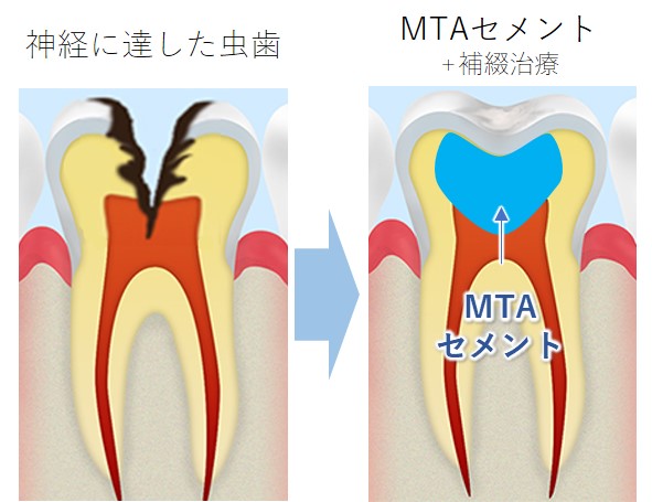 横浜市港北区の歯医者、トレッサファミリー歯科でMTAセメント