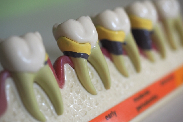 横浜市港北区の歯医者、トレッサファミリー歯科の歯ぎしり対策