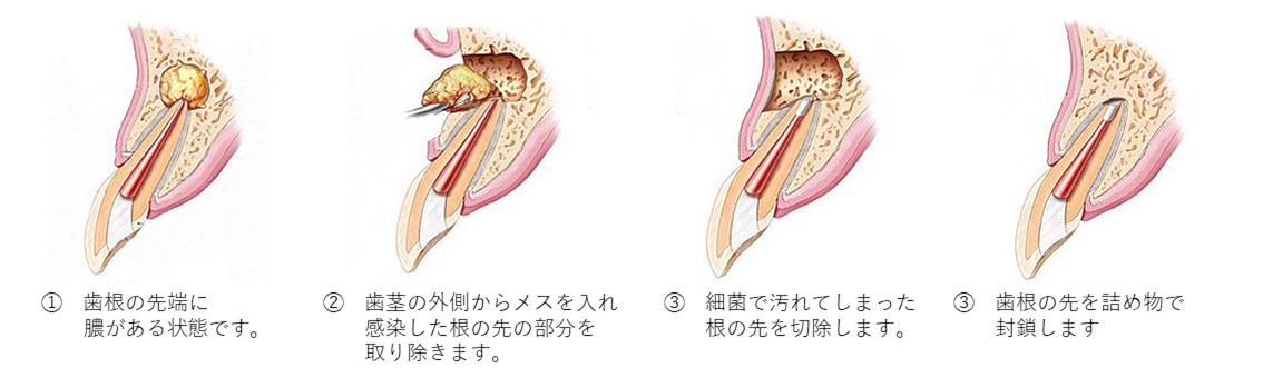 横浜市港北区の歯医者、トレッサファミリー歯科で歯根端切除術