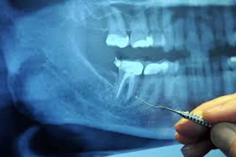 横浜市港北区の歯医者、トレッサファミリー歯科で親知らずの抜歯